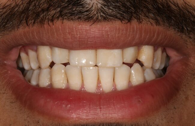 After (Teeth)