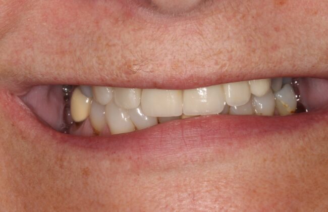 After (Teeth)