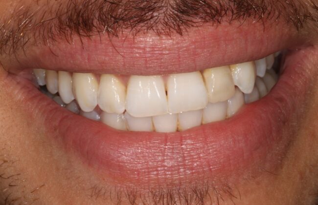 After (Teeth)