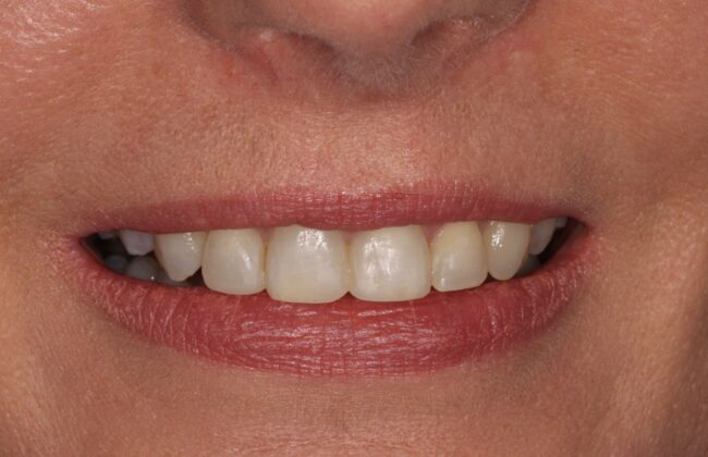 After (Teeth)