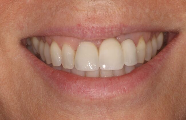 After (Teeth)