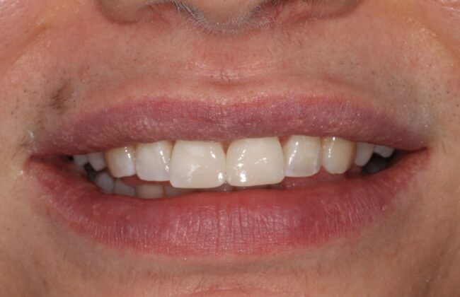 After (Teeth)