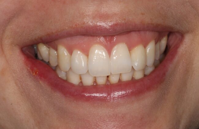 After (Teeth)
