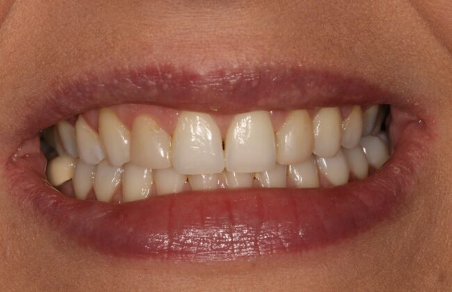 After (Teeth)