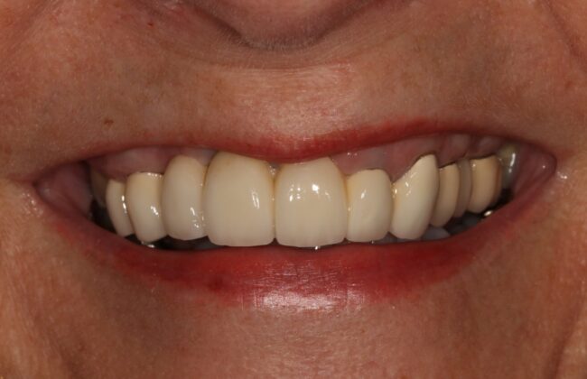 After (Teeth)