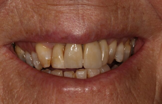 After (Teeth)
