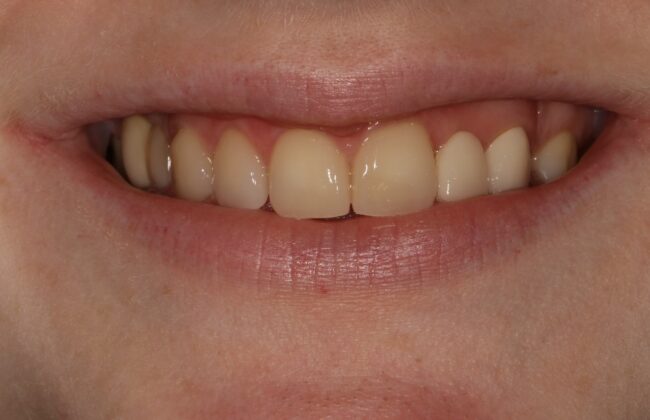 After (Teeth)