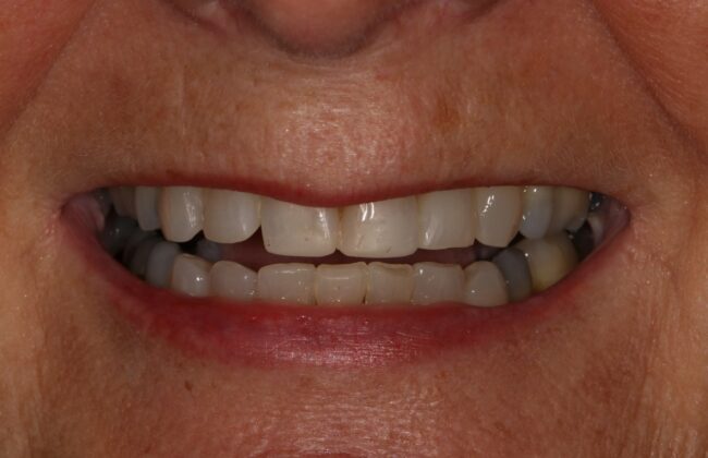 After (Teeth)