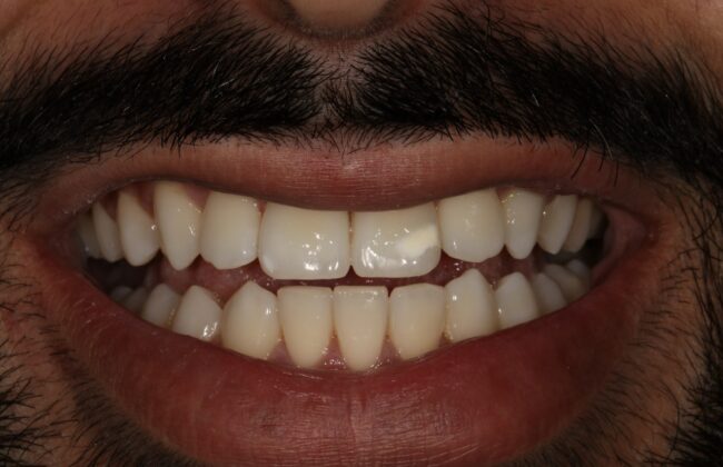After (Teeth)