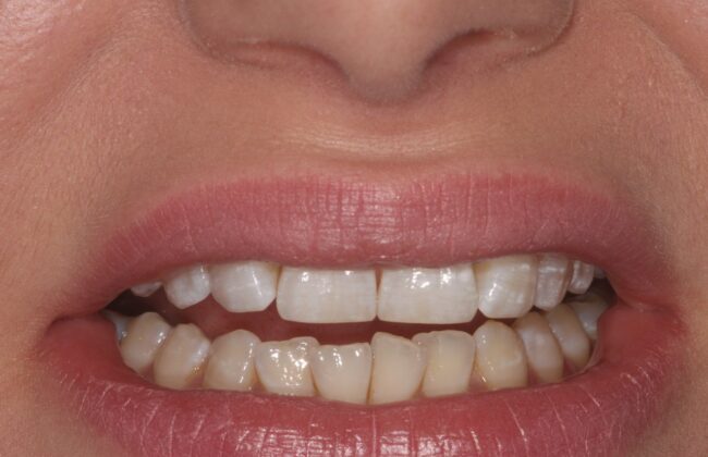 After (Teeth)