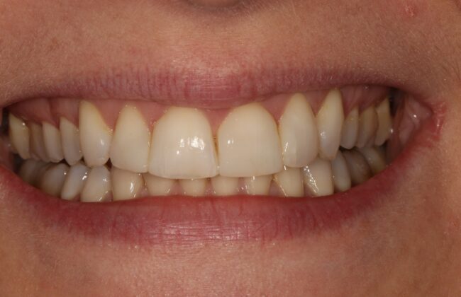 After (Teeth)