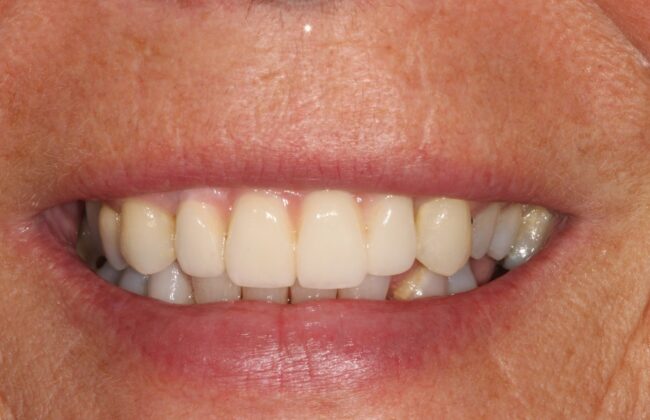 After (Teeth)