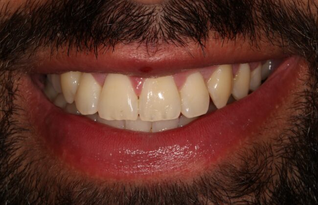 After (Teeth)