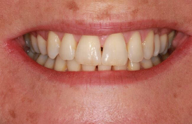 After (Teeth)