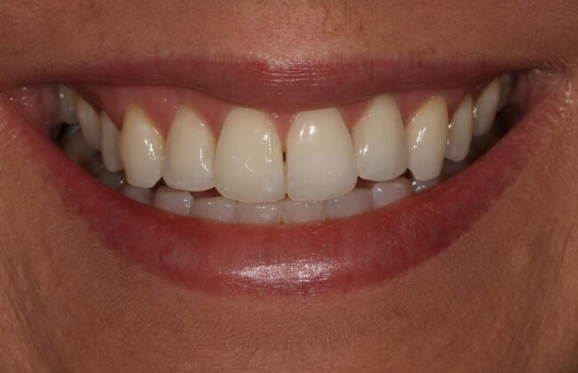 After (Teeth)