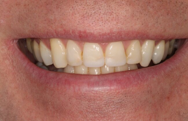 After (Teeth)