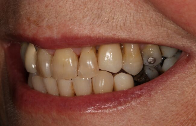 After (Teeth)