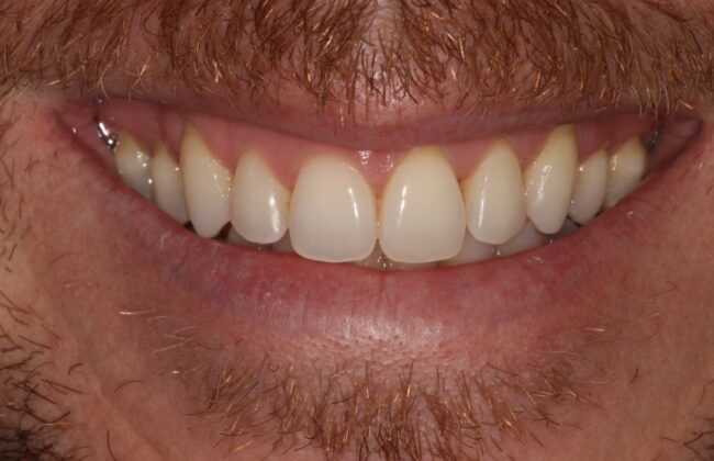 After (Teeth)
