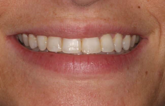 After (Teeth)