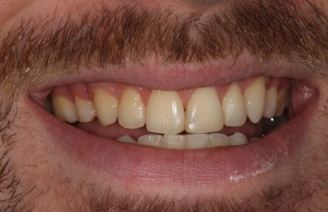 After (Teeth)