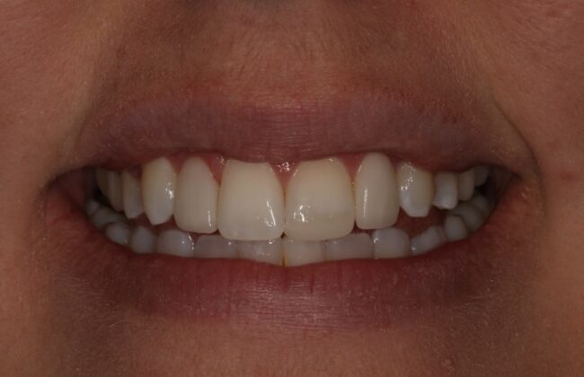 After (Teeth)