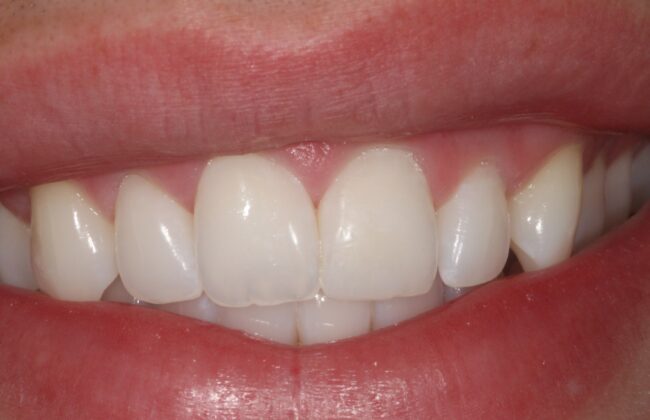 After (Teeth)