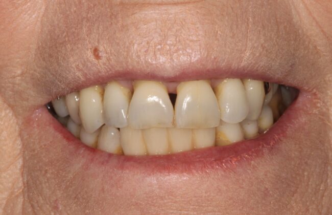 After (Teeth)