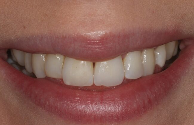 After (Teeth)