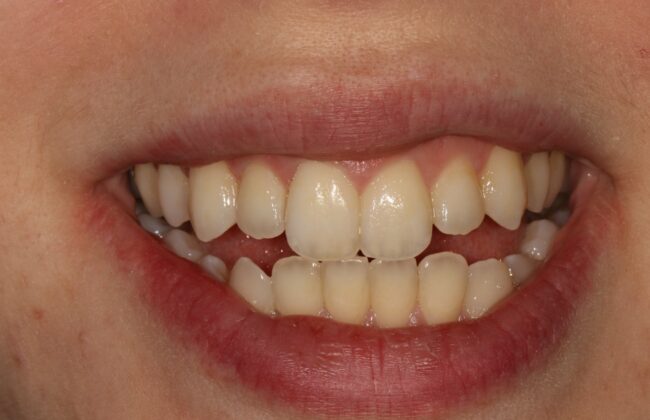 After (Teeth)