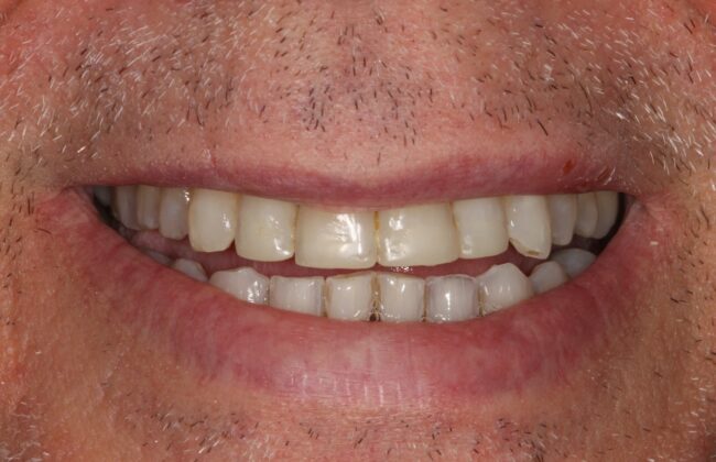 After (Teeth)