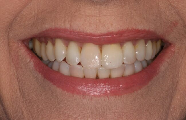 After (Teeth)