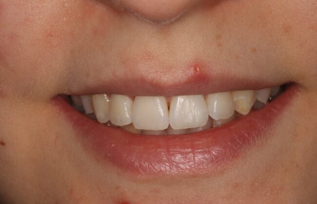 After (Teeth)