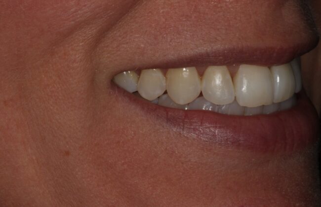 After (Teeth)