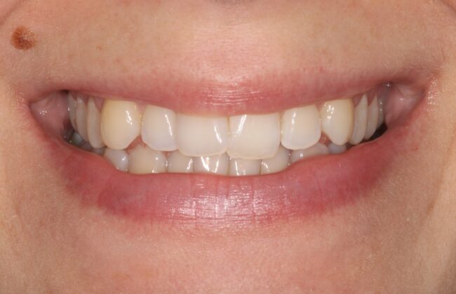 After (Teeth)