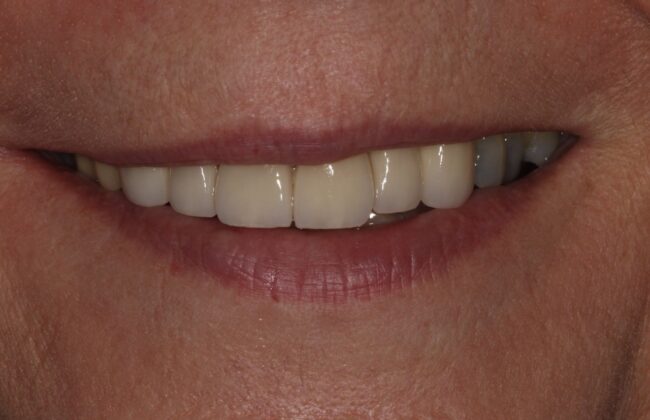 After (Teeth)