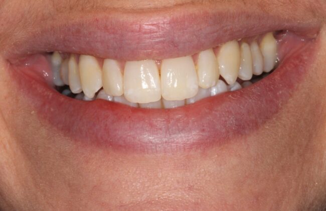 After (Teeth)