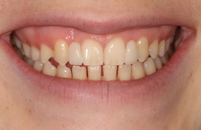 After (Teeth)