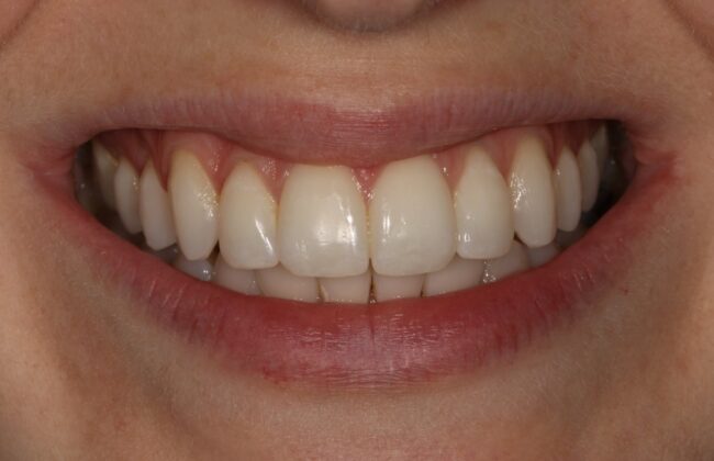 After (Teeth)