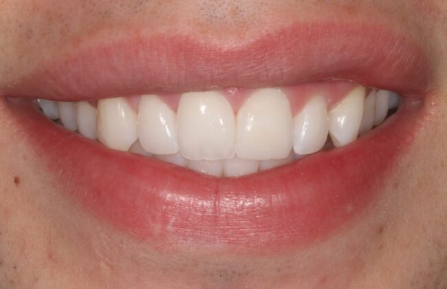 After (Teeth)