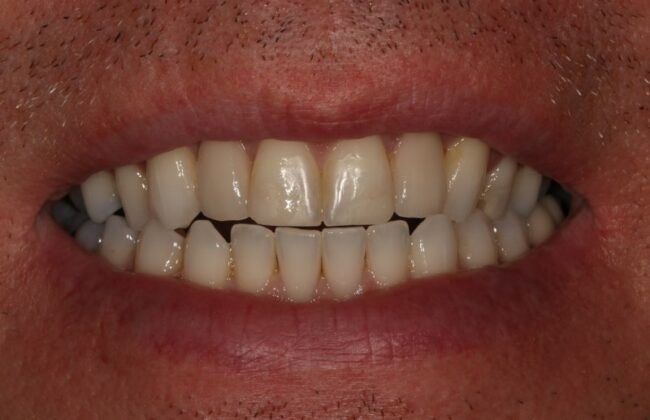 After (Teeth)