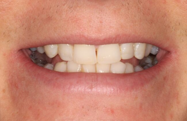 After (Teeth)
