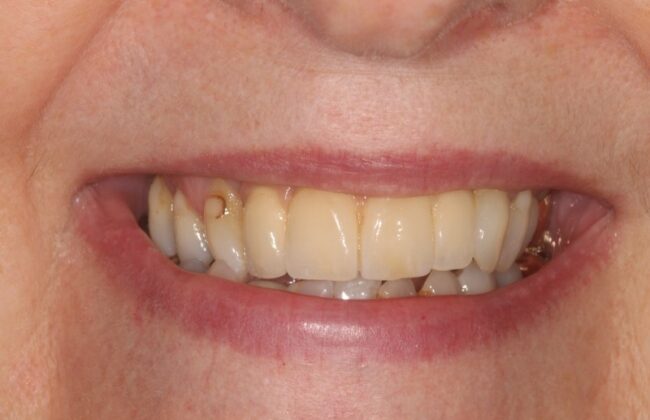 After (Teeth)