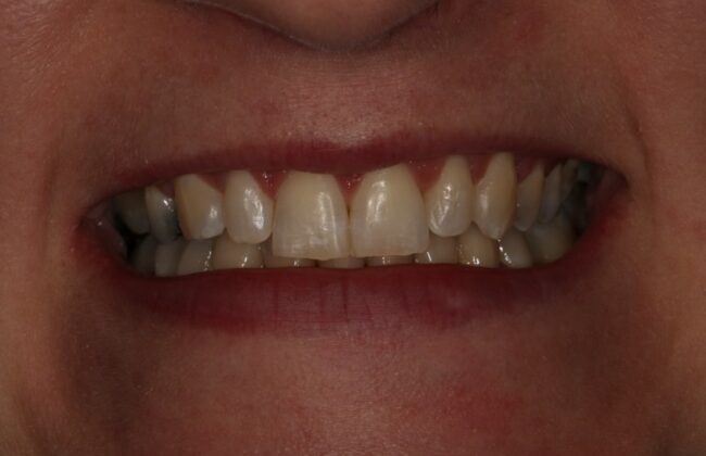 After (Teeth)