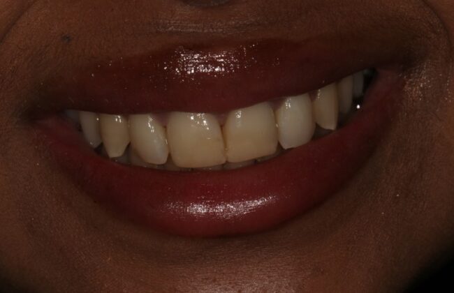 After (Teeth)