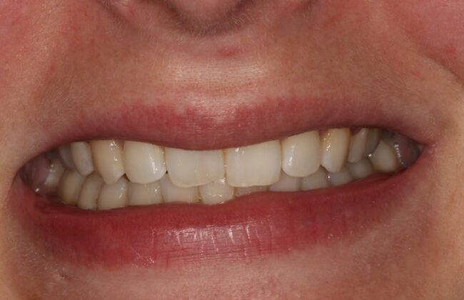 After (Teeth)