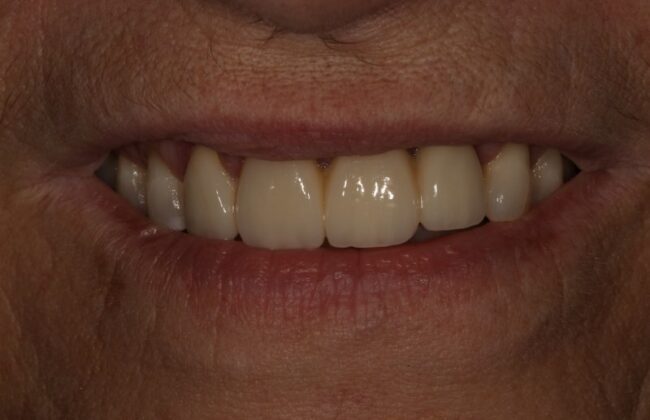 After (Teeth)