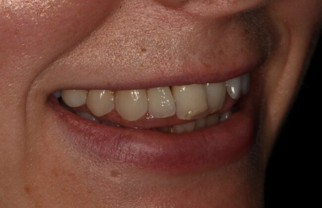 After (Teeth)