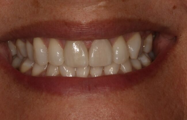 After (Teeth)