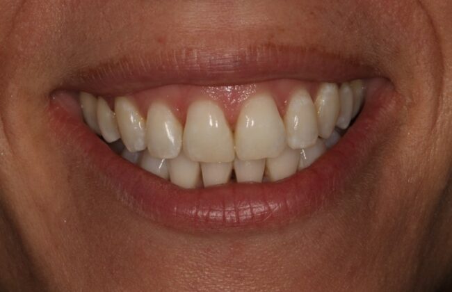 After (Teeth)