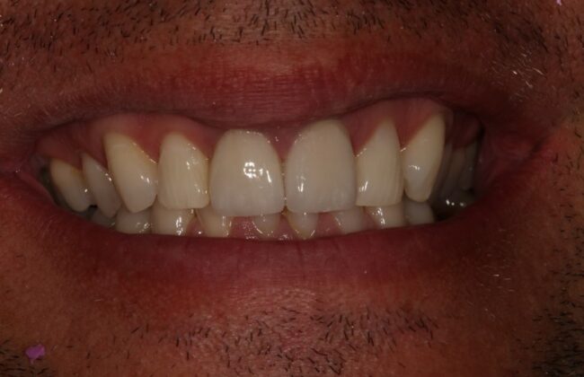 After (Teeth)